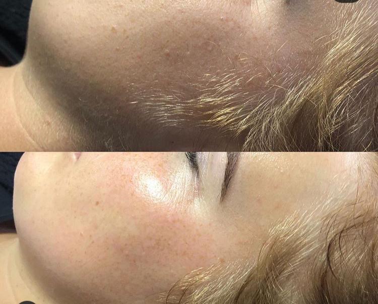 Dermaplaning voor en na 1